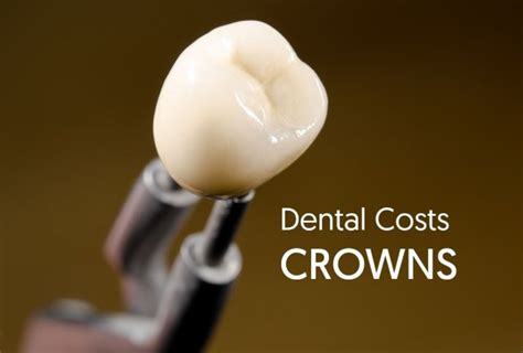 As of 2020, here are the basic dental charges defined by NSDA. . Average cost of dental crown 2020